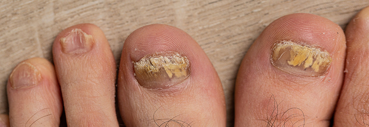 Combatting Toenail Fungus: 3 Key Strategies and 3 Pitfalls to Sidestep